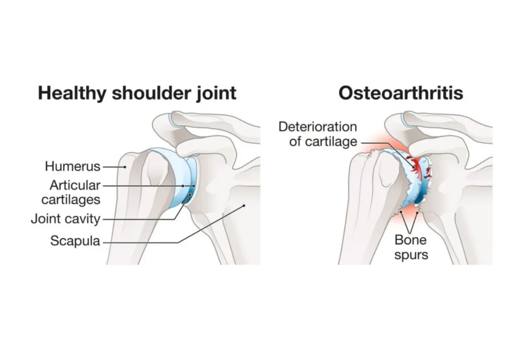Osteoarthritis