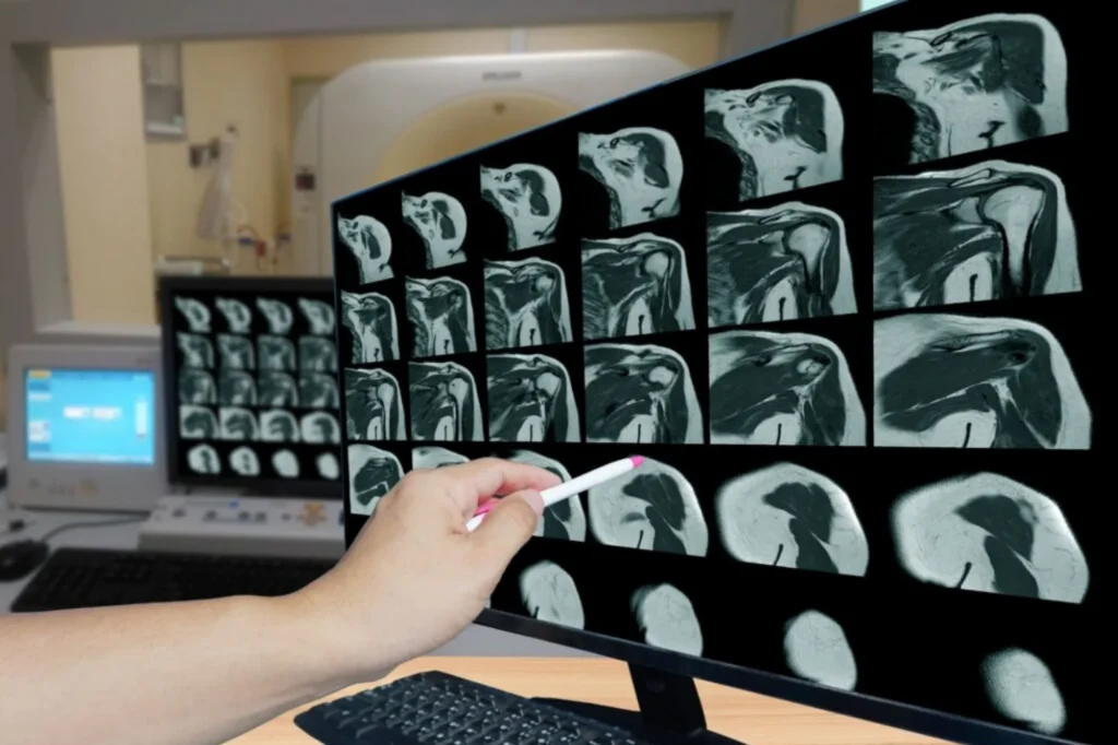 Shoulder X-Ray